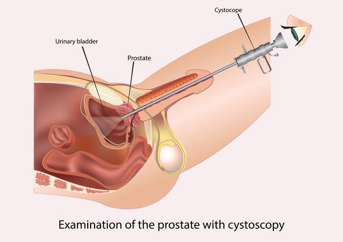 Цистоскопия при камнях в почках