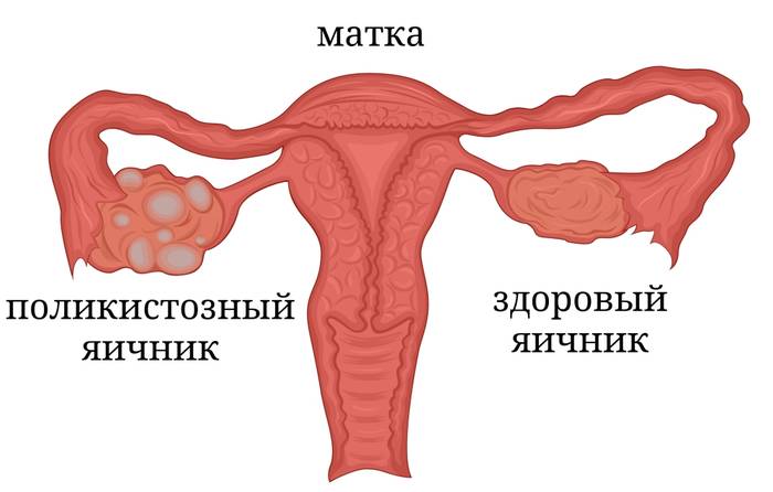 наличие большого количества кист при СКПЯ