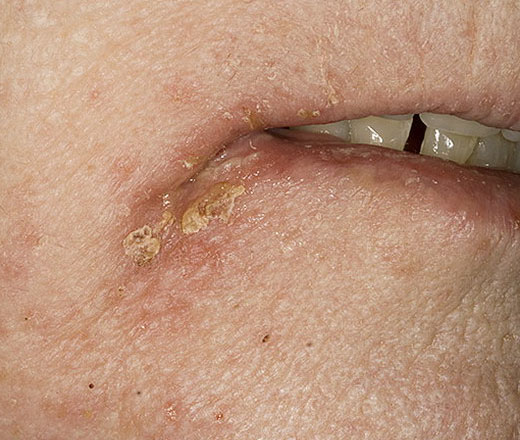 Стрептодермия в уголках губ 18