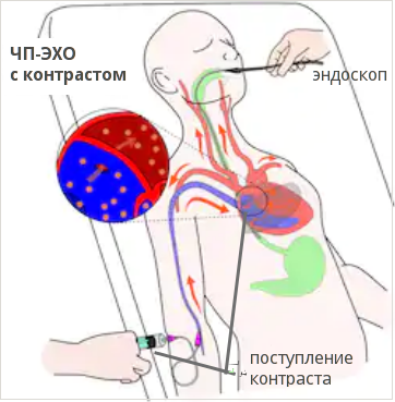 как проводится ЧП-ЭХО с контрастом