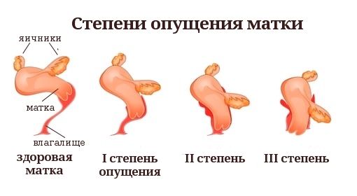 степени опущения матки